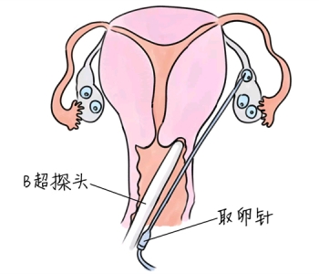 小儿退烧推拿手法 5种兰州捐卵宝宝退烧按摩方法